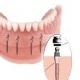 Miniimplanty zębowe (M.D.I.)